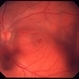 Intermediate Uveitis